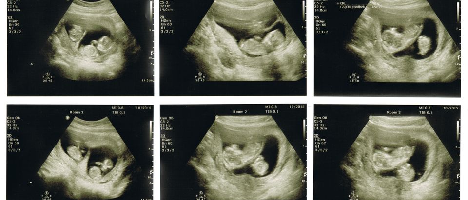 A compilation of six ultrasound scans show baby twins in utero at 12 weeks with scans of the twins together and seen separately. Shutterstock image via user Semmick Photo.