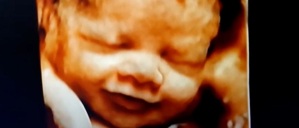 HD 3D 4D Ultrasound Screenshot Fetal Imaging