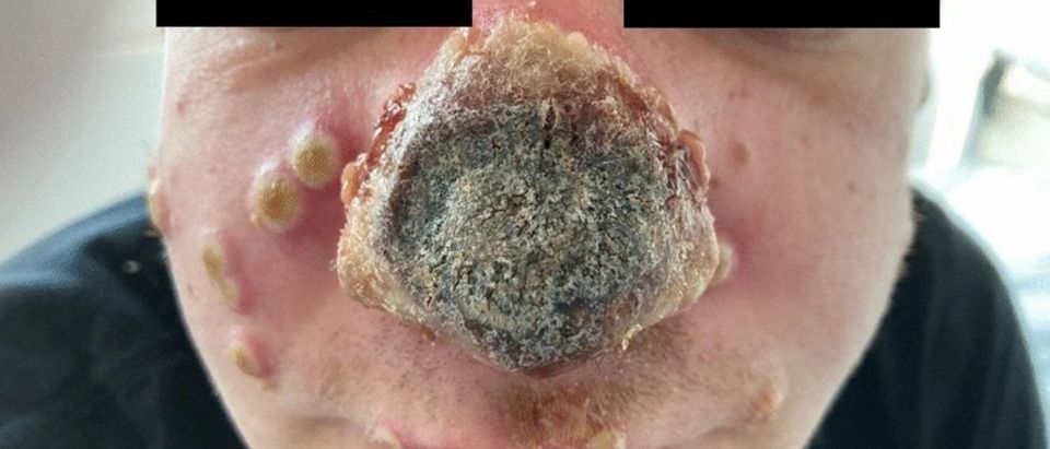 Man’s Nose Rots After Monkeypox, Syphilis, and HIV Infection