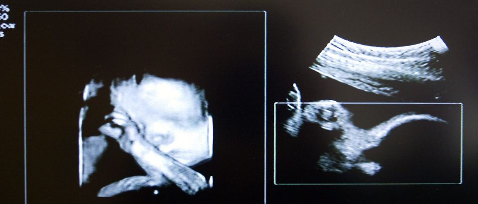 The Phillips 3D ultrasound showing an unborn child